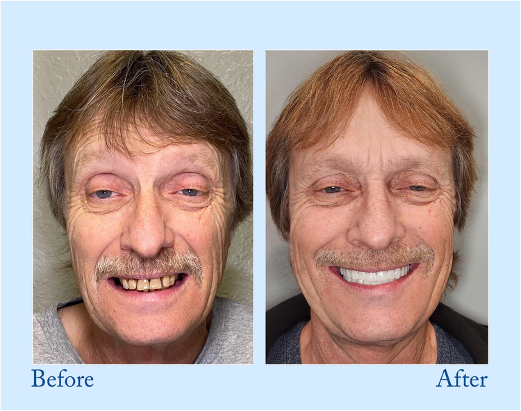 TrueEase™ Dentures