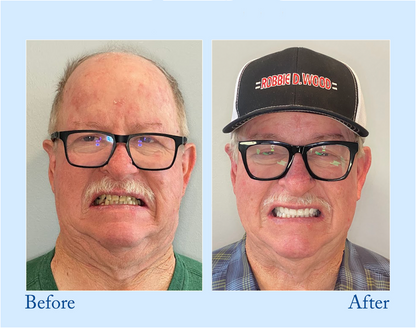 TrueEase™ Dentures