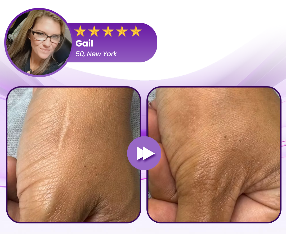 🔥LOVILDS® RevivaDerma Face & Body Scar Gel - Clinically proven to soften, flatten and fade surgical scars, acne marks, burns, keloids and trauma-related scars