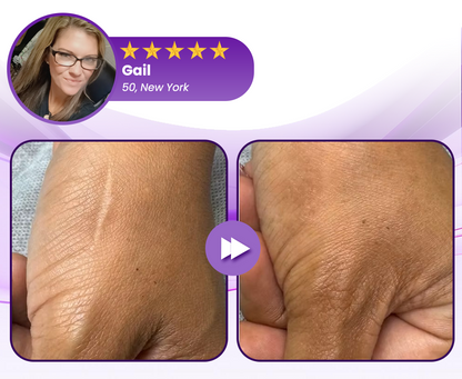 🔥LOVILDS® RevivaDerma Face & Body Scar Gel - Clinically proven to soften, flatten and fade surgical scars, acne marks, burns, keloids and trauma-related scars