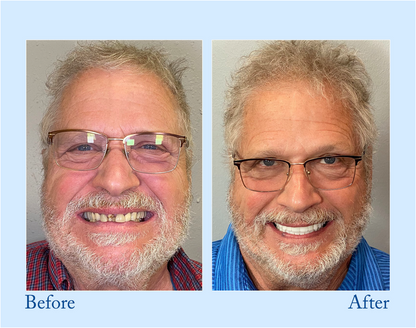 TrueEase™ Dentures