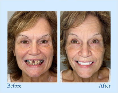 TrueEase™ Dentures